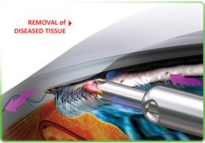 Trabectom AAO Orlando 211