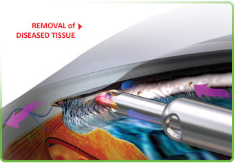 Trabectom AAO Orlando 211