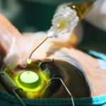 Korneal Kollajen Cross-linking