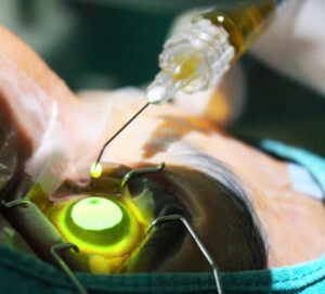 Korneal Kollajen Cross-linking