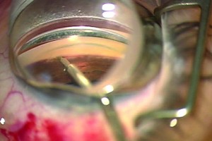 Trabectome Ab Interno Surgery