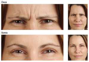 Blefarospazm Botox tedavisi