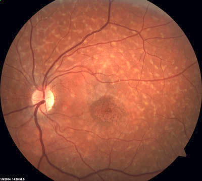 Fundus Flavimakulatus