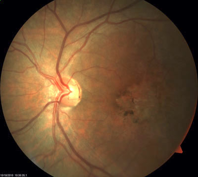 Stargardt Makula Distrofisi