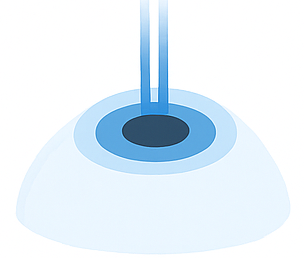 Kollajen doku ekleme: kornea üzerinde kollajen implant temsili