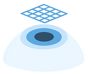 Kollajen doku ekleme: kornea üzerinde kollajen implant temsili